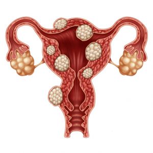 Women's Health Uterine Fibroids Treatment